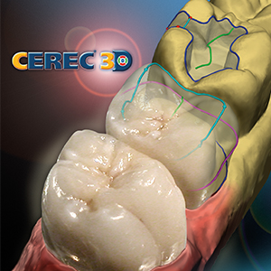 CEREC Same-Day Crowns